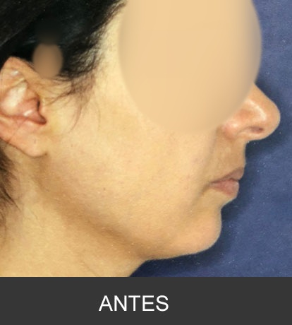 Cirugía Ortognática para corrección de mandíbula corta o deficiente