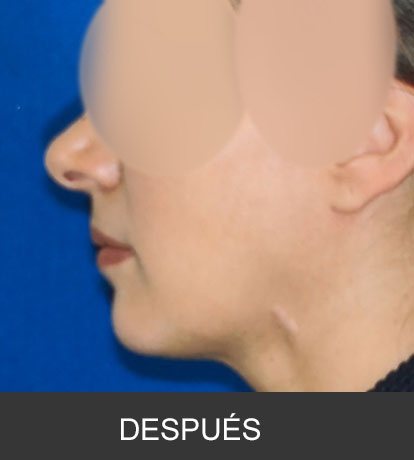Cirugía Ortognática para corrección de mandíbula corta o deficiente