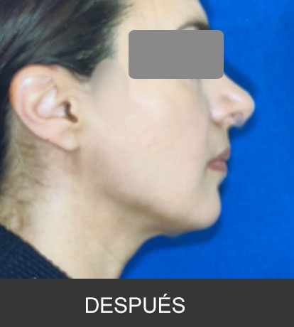 Cirugía Ortognática para corrección de mandíbula corta o deficiente