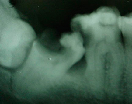 Wisdom tooth extraction X-ray