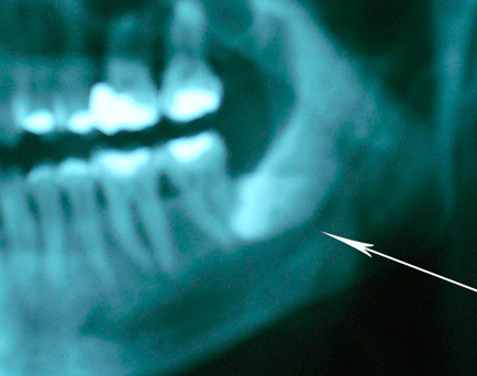 Wisdom tooth extraction X-ray
