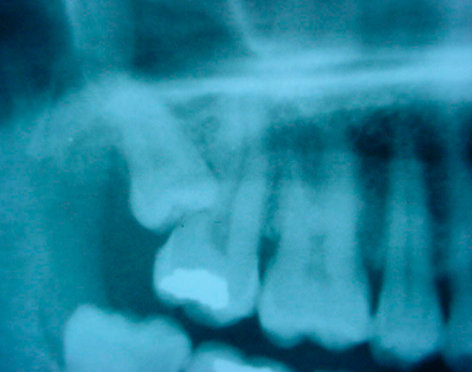 Wisdom tooth extraction X-ray