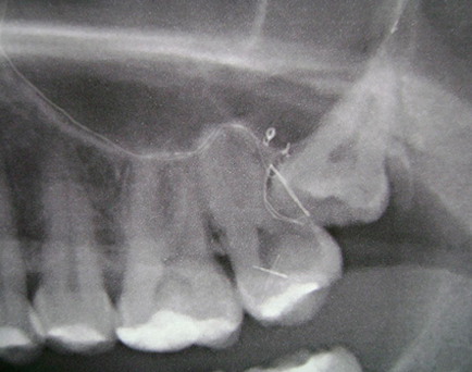 Wisdom tooth extraction X-ray