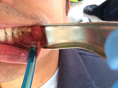 Clinical case: wisdom tooth extraction