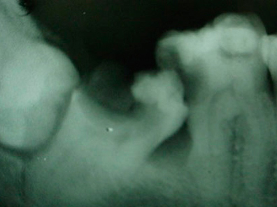 Clinical case: wisdom tooth extraction
