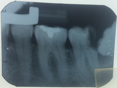 Clinical case: wisdom tooth extraction