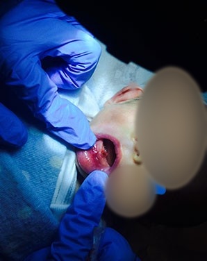 Extracción de DIENTES ECTÓPICOS - Cirujano Maxilofacial CDMX