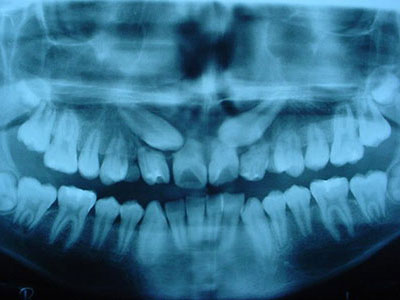 Extracción de DIENTES INCLUIDOS - Cirujano Maxilofacial CDMX