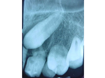 Extracción de DIENTES INCLUIDOS - Cirujano Maxilofacial CDMX