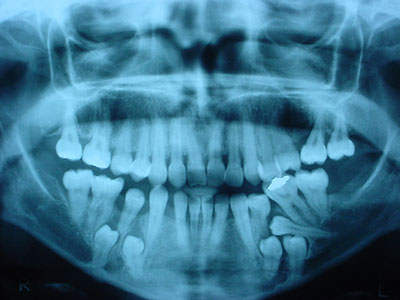 Extracción de DIENTES INCLUIDOS - Cirujano Maxilofacial CDMX