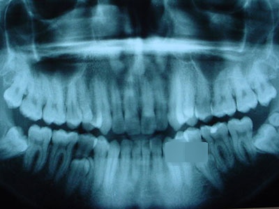 Extracción de DIENTES INCLUIDOS - Cirujano Maxilofacial CDMX