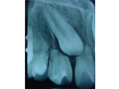 Extracción de DIENTES INCLUIDOS - Cirujano Maxilofacial CDMX