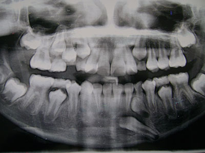 Extracción de DIENTES INCLUIDOS - Cirujano Maxilofacial CDMX