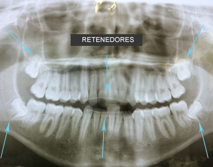 Clinical case: crowding due to third molars