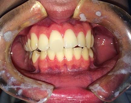 Clinical case: crowding due to third molars