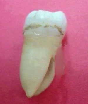 Clinical case: anatomical alteration