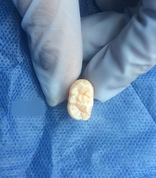 Clinical case: anatomical alteration