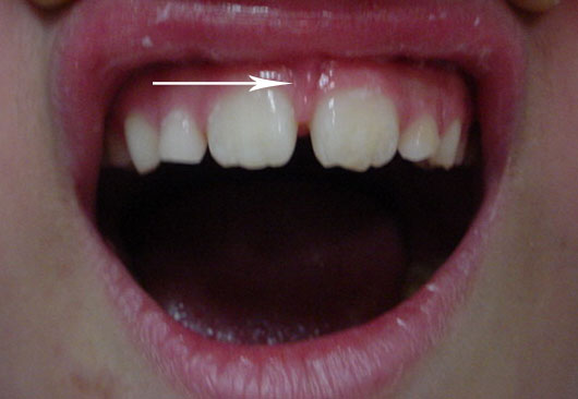 Eliminación de frenillos - Cirujano Maxilofacial CDMX