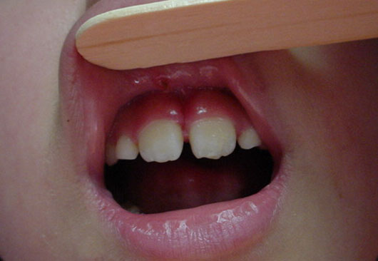 Eliminación de frenillos - Cirujano Maxilofacial CDMX