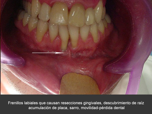 Eliminación de frenillos - Cirujano Maxilofacial CDMX