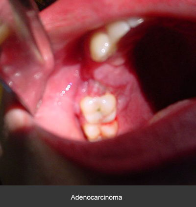 Detección adenocarcinoma - Cáncer bucal