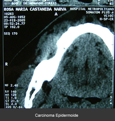 Detección carcinoma epidermoide - Cáncer bucal
