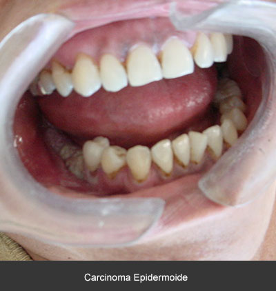 Detección carcinoma epidermoide - Cáncer bucal