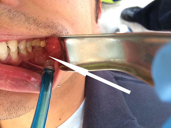 DETECCIÓN DE CÁNCER BUCAL LEUCOPLASIA EN MAXILOFACIAL CDMX