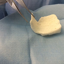 Colocación de Injertos mandibulares a la medida Maxilofacial CDMX