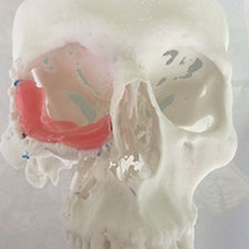 Colocación de Injertos mandibulares Maxilofacial CDMX