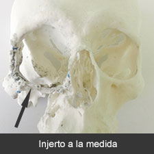 Colocación de injertos diseñados a la medida