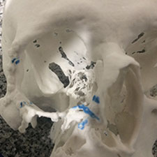 Colocación de Injertos mandibulares Maxilofacial CDMX