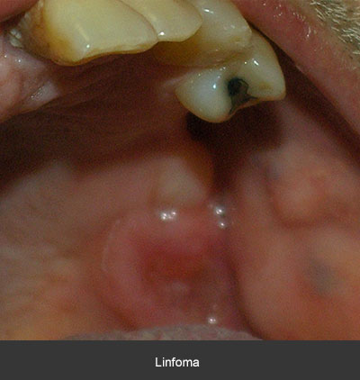 Detección linfoma - Cáncer bucal