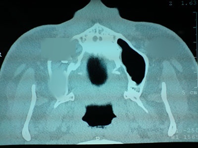 Comunicación bucosinusal posterior a una extracción dental
