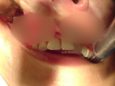 Comunicación bucosinusal posterior a una extracción dental