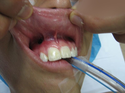 Comunicación bucosinusal posterior a una extracción dental