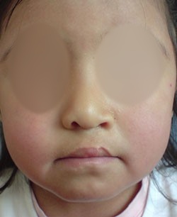 Corrección de labio y paladar hendido en CDMX
