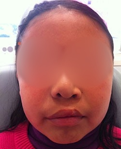 Corrección de labio y paladar hendido en CDMX
