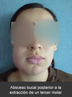 Absceso bucal posterior a la extracción de un tercer molar