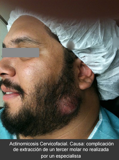 Diagnóstico y tratamiento de las infecciones dentales