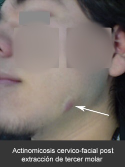 Actinomicosis cervico-facial post extracción de tercer molar