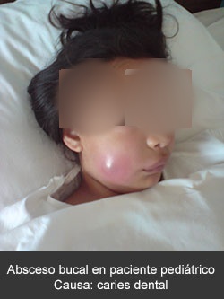 Absceso bucal en paciente pediátrico por caries dental