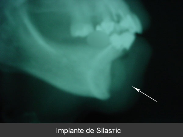 Retiro de implantes de Silastic por infección