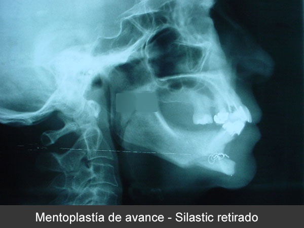 Retiro de implantes de Silastic por infección