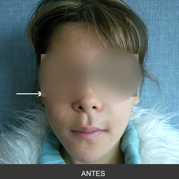 Retiro de implantes de Silastic por infección
