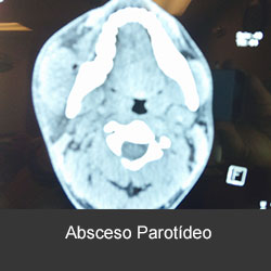 tratamiento de las infecciones dentales y cérvico faciales