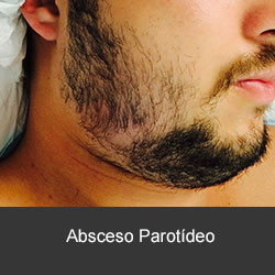 tratamiento de las infecciones dentales y cérvico faciales
