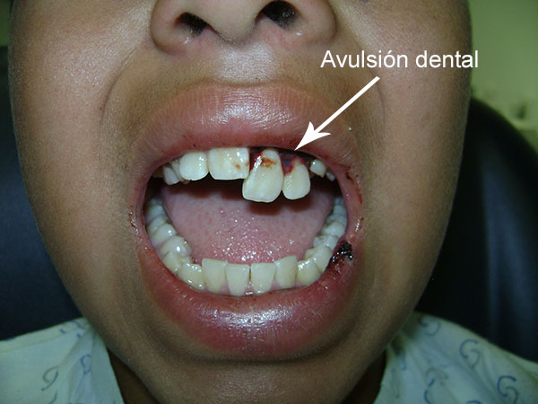 avulsión dental Maxilofacial CDMX