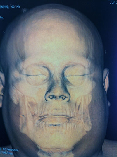 Fractura de ángulo mandibular Cirujano Maxilofacial CDMX