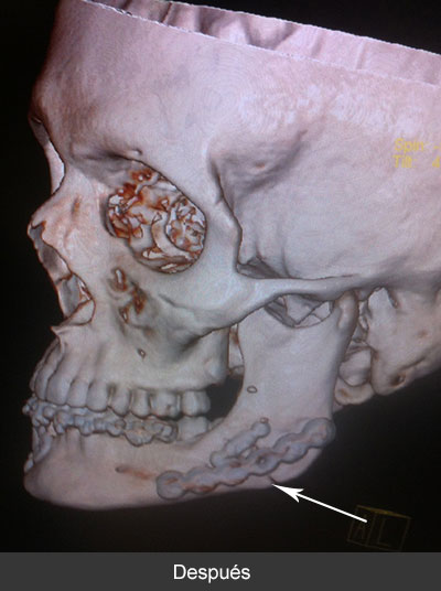 Fractura de ángulo mandibular Cirujano Maxilofacial CDMX